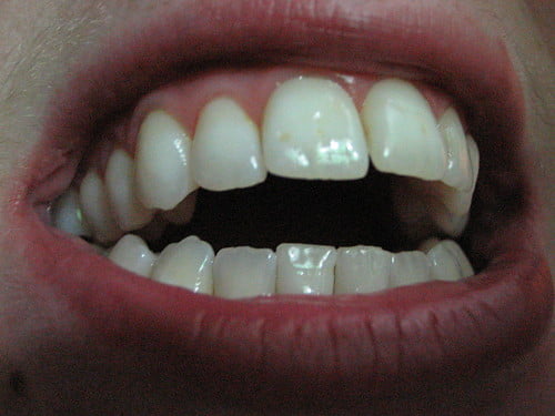 177784859_c562bf21cc_teeth