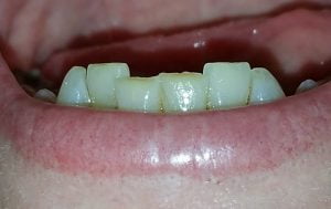26480291681 f6d43bdf5c teeth filling 26480291681_f6d43bdf5c_teeth-filling