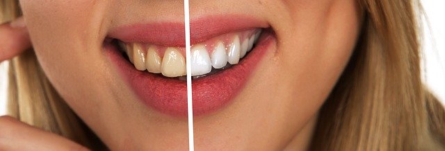 Diş beyazlatma ne kadar?